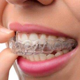 Invisalign